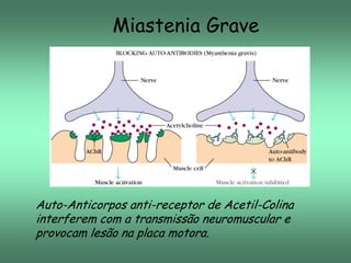 Miastenia Grave

Auto-Anticorpos anti-receptor de Acetil-Colina
interferem com a transmissão neuromuscular e
provocam lesão na placa motora.

 