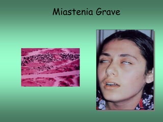 Miastenia Grave

 