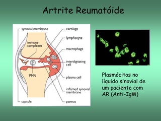 Artrite Reumatóide

Plasmócitos no
líquido sinovial de
um paciente com
AR (Anti-IgM)

 