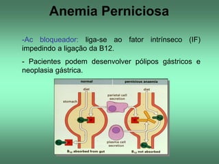 Anemia Perniciosa
-Ac bloqueador: liga-se ao fator intrínseco (IF)
impedindo a ligação da B12.
- Pacientes podem desenvolver pólipos gástricos e
neoplasia gástrica.

 