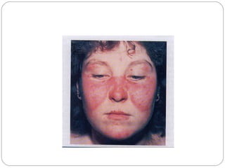 Gambar.: Rash berbentuk seperti
kupu-kupu pada penderita SLE
 