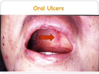 Oral Ulcers
 