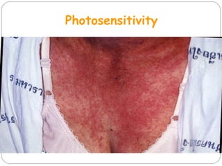 Photosensitivity
 