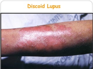 Discoid Lupus
 
