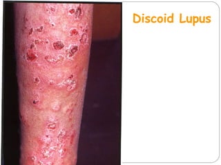 Discoid Lupus
 