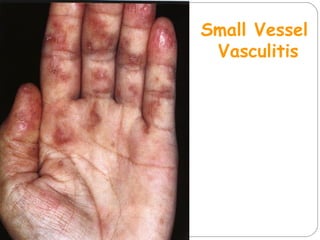Small Vessel
Vasculitis
 