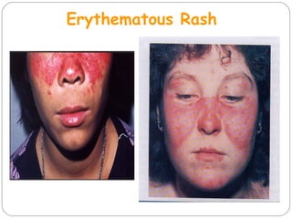 Erythematous Rash
 