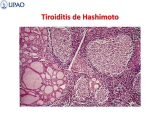 Tiroiditis de Hashimoto
 