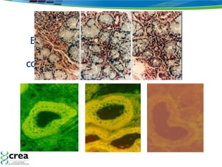 El Síndrome de Sjögren  (resequedad de mucosas por compromiso inflamatorio de éstas)  es una Enfermedad Autoinmune SSp-1 SSp-2 CTR 