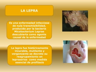 LA LEPRA
Es una enfermedad infecciosa
de nula transmisibilidad,
producida por la bacteria
Micobacterium Leprae
descubierta como agente
causal de la enfermedad
La lepra fue históricamente
incurable, mutilante y
vergonzante se decreto su
reagrupamiento en
leprosorios como medida
esencial de profilaxis
 