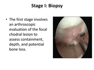Stage I: Biopsy
• The first stage involves
an arthroscopic
evaluation of the focal
chodral lesion to
assess containment,
depth, and potential
bone loss.
 