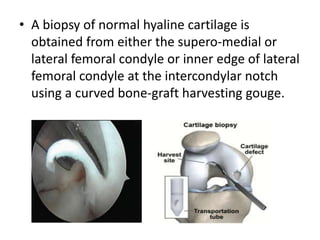 • A biopsy of normal hyaline cartilage is
obtained from either the supero-medial or
lateral femoral condyle or inner edge of lateral
femoral condyle at the intercondylar notch
using a curved bone-graft harvesting gouge.
 