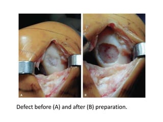 Defect before (A) and after (B) preparation.
 