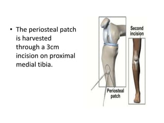 • The periosteal patch
is harvested
through a 3cm
incision on proximal
medial tibia.
 