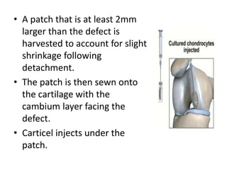 • A patch that is at least 2mm
larger than the defect is
harvested to account for slight
shrinkage following
detachment.
• The patch is then sewn onto
the cartilage with the
cambium layer facing the
defect.
• Carticel injects under the
patch.
 