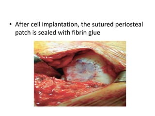 • After cell implantation, the sutured periosteal
patch is sealed with fibrin glue
 