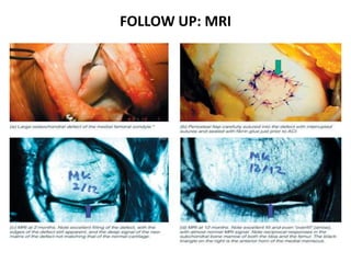FOLLOW UP: MRI
 