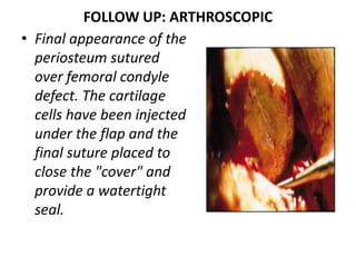 FOLLOW UP: ARTHROSCOPIC
• Final appearance of the
periosteum sutured
over femoral condyle
defect. The cartilage
cells have been injected
under the flap and the
final suture placed to
close the "cover" and
provide a watertight
seal.
 