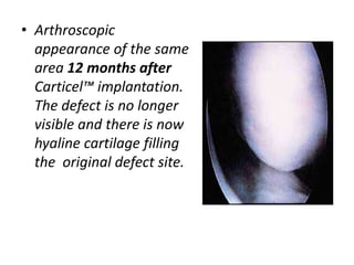 • Arthroscopic
appearance of the same
area 12 months after
Carticel™ implantation.
The defect is no longer
visible and there is now
hyaline cartilage filling
the original defect site.
 