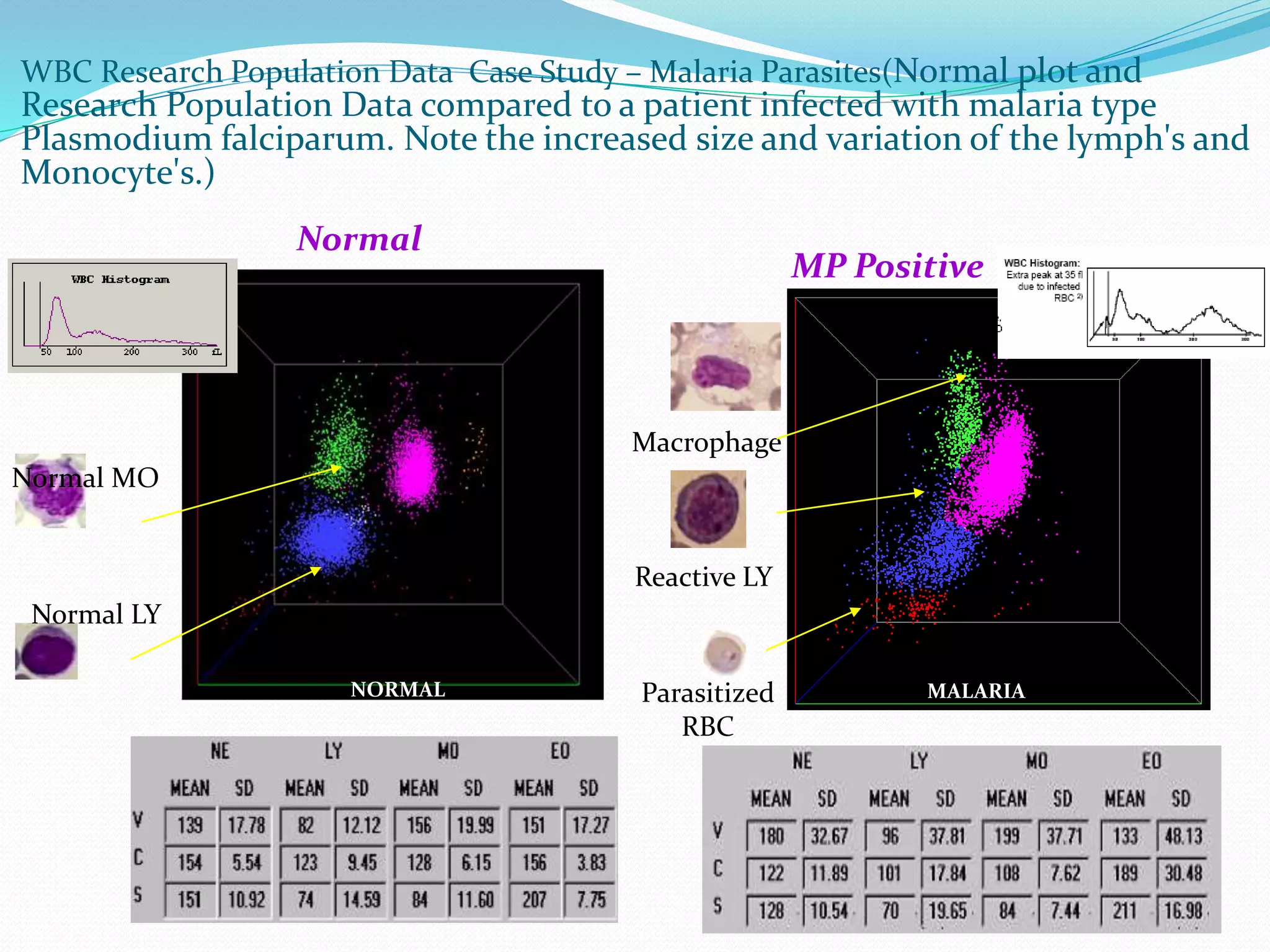 WBC Research Population Data Case Study – Malaria Parasites(Normal plot and
Research Population Data compared to a patient infected with malaria type
Plasmodium falciparum. Note the increased size and variation of the lymph's and
Monocyte's.)
NORMAL
Normal
Normal MO
Normal LY
Macrophage
Parasitized
RBC
MALARIA
MP Positive
Reactive LY
 