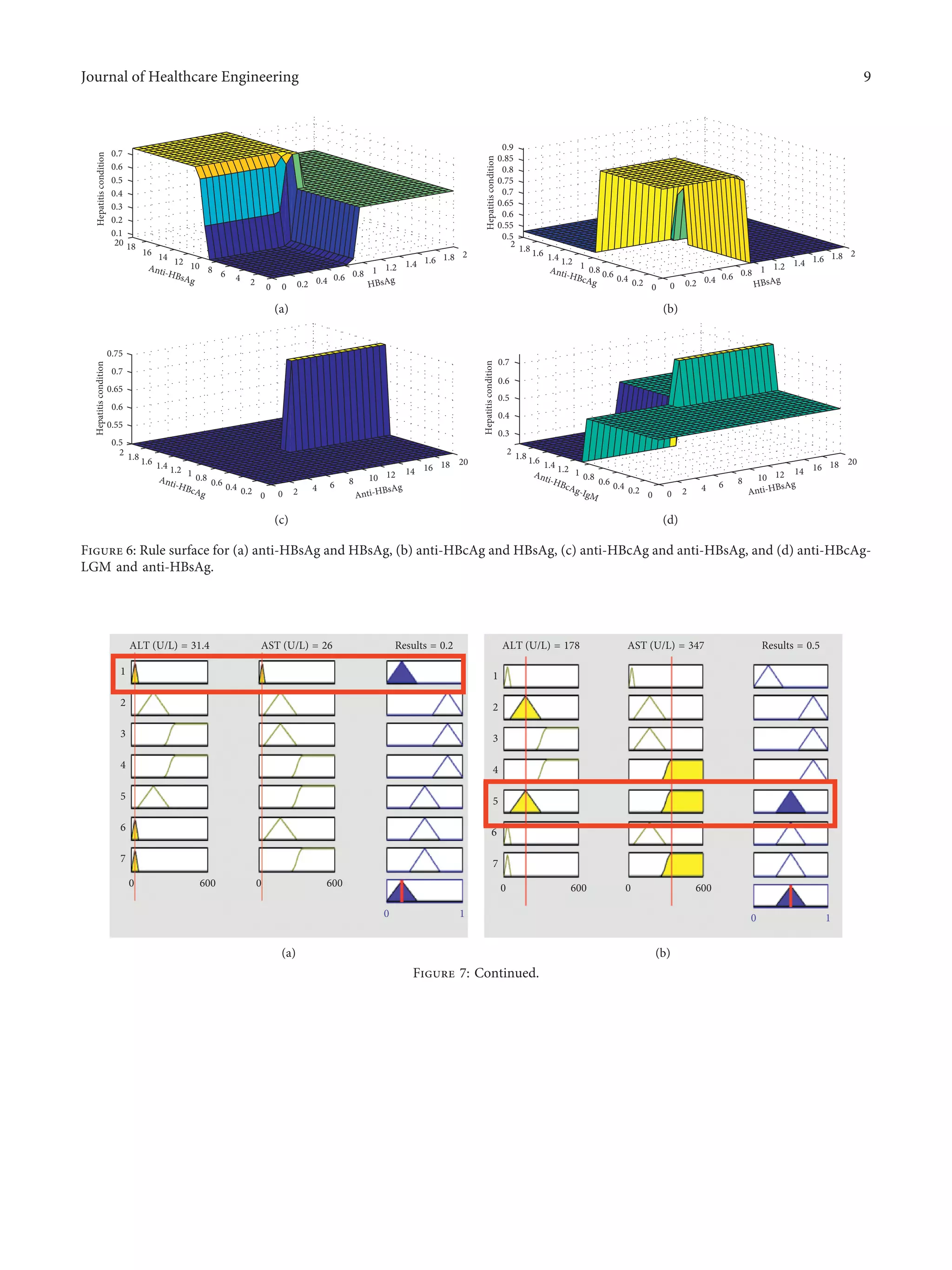 1
ALT (U/L) = 31.4 AST (U/L) = 26 Results = 0.2
2
3
4
5
6
7
0 0600 600
0 1
(a)
ALT (U/L) = 178 AST (U/L) = 347 Results = 0.5
1
2
3
4
5
6
7
0 600 0 600
0 1
(b)
Figure 7: Continued.
Hepatitiscondition
21.81.61.41.21
0.6 0.8
0.40.20 HBsAg
Anti-HBsAg
0.7
0.6
0.5
0.4
0.3
0.2
0.1
20 18
16 14 12 10 8 6 4 2
0
(a)
Hepatitiscondition
21.81.61.41.21
0.6 0.8
0.40.20 HBsAg
Anti-HBcAg
0.8
0.85
0.9
0.75
0.7
0.65
0.6
0.55
0.5
2 1.8 1.6 1.4 1.2 1 0.8 0.6 0.4 0.2 0
(b)
Hepatitiscondition
201816141210
6 8
420
0.75
0.7
0.65
0.6
0.55
0.5
2 1.8 1.6 1.4 1.2 1 0.8
0.6 0.4 0.2 0
Anti-HBcAg Anti-HBsAg
(c)
Hepatitiscondition
201816141210
6 8
420
0.6
0.7
0.5
0.4
0.3
2 1.8 1.6 1.4 1.2 1 0.8
0.6 0.4 0.2 0
Anti-HBcAg-IgM Anti-HBsAg
(d)
Figure 6: Rule surface for (a) anti-HBsAg and HBsAg, (b) anti-HBcAg and HBsAg, (c) anti-HBcAg and anti-HBsAg, and (d) anti-HBcAg-
LGM and anti-HBsAg.
Journal of Healthcare Engineering 9
 