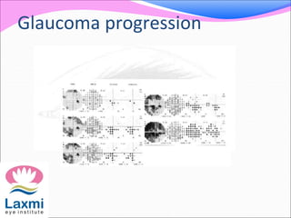 Glaucoma progression
 