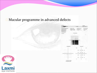  Macular programme in advanced defects
 