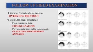 Without Statistical assisteance-
OVERVIEW PRINTOUT
With Statistical assistance
• From normative data-
CHANGE ANALYSIS
• Previous data from stable glaucoma pt.-
GLAUCOMA PROGRESSION
ANALYSIS
 