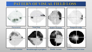 Paracentral Nasal Step Siedel’s Scotoma Temporal wedge
Arcuate scotoma Breakthrough to periphery Double Arcuate Central Island of vision
 