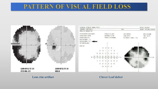 Lens rim artifact Clover Leaf defect
 