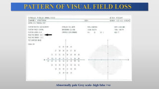 Abnormally pale Grey scale- high false +ve
 