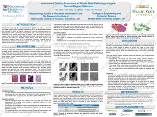 Automated Quality Assurance in Whole Slide Pathology Images:
Blurred Region Detection
13R. Bhat, 123B. Kelly, 2D. Billiter, 1T. Barr, 1N. Ramirez
1Biopathology Center & 2Research Informatics Core
The Research Institute at
Nationwide Children’s Hospital, Columbus, OH
3College of Engineering and
Computer Science
Wright State University, Dayton, OH
Virtual microscopy (VM) is a growing field where glass tissue slides are scanned
to a digital image. Digital pathology, enabled by VM, is an image-based process
that provides the ability to acquire, manage and interpret pathology cases from
digitized glass slides. Challenges exist, however, and a wide range of issues can
contribute to an overall lower quality of image. One such issue, blurriness,
causes a loss of important image data and thus results in a significant amount of
staff time and effort to manually assess these whole slide images. The
Biomedical Imaging Team (BIT) at Nationwide Children’s Hospital aims to
automate the detection of blurred regions in these images and reduce the
manual labor involved in quality assurance.
Blurring in whole slide pathology images (WSI) occurs because of software and
hardware errors, vibrations during scanning, incorrect focus point placement,
tissue folds and other factors. Blurriness in an image obscures image data,
causing problems for pathologists who have to formulate a diagnosis based on
these images. Image analysis algorithms also often have difficulty overcoming
blurry image quality.
In order to detect poor quality images before they reach the pathologists and
analysis algorithms, imaging technicians assess the quality after scanning,
assuring the image does not have any prohibitively blurred regions. If the image is
of insufficient quality, rescanning of the entire image is repeated until the proper
quality has been attained. While automated rescanning isn’t available, image
analysis can automate the quality assessment step. The Blurred Region
Detection algorithm developed by the Biomedical Imaging Team (BIT) scores the
severity of blurring within a WSI and annotates the image for rapid assessment of
whether the image needs to be rescanned.
Figure 1. Examples of blurred sections from whole slide pathology images
The algorithm makes use of the idea that blurred and non-blurred regions can be
distinguished on the basis of homogeneity and contrast. In this algorithm, the
differences are quantified using numerical gradients. More gradients are found in
clear, in-focus regions as compared to blur regions.
Calculation of metric
• A block of tissue is first blurred using an averaging filter to attain a distinct
pair of images.
• The number of gradients in the original image and its blurred version are
calculated.
• Gradient counts are normalized by the number of colored pixels in the block.
A metric for each block is produced by the following formula:
Blocks are then classified by their metric as good (green), passable (yellow), or
not passable (red). These are used to annotate the WSI for visual inspection by
the imaging technicians (as seen in Figure 3). A global metric is also calculated
using the following formula:
a) b) e) f)
c) d) g) h)
Figure 2: a) Blurry image. b) Gradient image of 2a. c) Image 2a blurred four times.
d) Gradient image of 2c. e) Clear image. f) Gradient image of 2e. g) Image 2e
blurred four times. h) Gradient image of 2e.
Expert imaging technicians were asked to manually assess 52 WSI consisting of
quality and poor images. Technicians were asked to grade each WSI as good,
passable, and non-passable. They were asked to only focus on the blurring
issues. The algorithm’s global metric and the distribution of good and poor blocks
within the image were each used to formulate a good, passable, or poor
algorithmic grade for each image.
Table 1: Amount of agreement between two algorithmic metrics and expert
imaging technicians.
The algorithm came to an agreement with the expert technicians on 88.4% of
the WSIs. The global metric, however, was not as effective in its assessment of
the entire image quality. A subset of blocks may have a metric which
contributes an inordinate amount in one direction or the other, thus moving the
global average with it. With the distribution metric, each block contributes
equally.
There are several specific situations where the algorithm and the technicians
were not in agreement:
• Over-staining: The image has dark blobs without sufficient definition,
though the technician may deem the tissue as sufficiently clear to pass.
• Under-staining: The algorithm may not be able to distinguish very lightly
colored tissue from the background of the slide.
• Thick tissue: While a technician may be able to look through the haziness
that a mix of out-of-focus and in-focus tissue can cause, the algorithm may
not. This haze reduces edge definition and the number of gradients that
will be found.
Future work
• The use of an image thumbnail to separate out completely white blocks and
applying the algorithm to only the block containing tissue could significantly
decrease computation time. Only a few pixels of the thumbnail would need
to be processed as opposed to an entire block’s worth of pixels.
• High performance computing and “bursting” to the cloud is in the testing
phase, and will assist the analysis of WSIs on a real time basis diminishing
the delay between scanning and quality assessment of the image.
• The precise annotation of the blurred areas in the form of region outlines
and contours instead of placing square blocks over a blur region would
create a more accurate visual representation.
1. Yun-Chung Chung; Jung-Ming Wang; Bailey, R.R.; Sei-Wang Chen; Shyang-Lih Chang; , "A
non-parametric blur measure based on edge analysis for image processing applications,"
Cybernetics and Intelligent Systems, 2004 IEEE Conference on , vol.1, no., pp. 356- 360 vol.1,
1-3 2004
2. Ping Hsu and Bing-Yu Chen. 2008. Blurred image detection and classification. In Proceedings
of the 14th international conference on Advances in multimedia modeling (MMM'08), pp. 277-
286.
3. Russ, John C., The Image Processing Handbook. Boca Raton: CRC, 2006.
INTRODUCTION
BACKGROUND
METHODS
RESULTS
DISCUSSION
REFERENCES
ACKNOWLEDGEMENTS
Reading the Image
• The WSI is broken into smaller, independent blocks for parallel processing.
• Image pixel data from the AperioTM proprietary format is accessed with the
aid of Bio-formats, an open-source Java library, within MATLABTM.
Screening of blocks
• Because biological tissue isn’t present over the entire WSI, blocks are
prescreened for whether they contain a significant amount of non-
background colored pixels.
• A block that is completely or nearly completely white is disregarded by the
algorithm to help reduce the computational time as they do not require
further processing.
• The remaining blocks then undergo a series of image processing steps and
a metric is calculated, measuring the amount of blurriness in a region.
a) b)
Figure 3: a) Annotated image with blocks outlined in red showing significantly
blurred regions and outlined in yellow showing mildly blurred regions b)
Blocks outlined in green showing clear, in-focus regions
Percent of WSI in agreement Agreement between:
78.8% Technicians and both algorithmic metrics
88.4% Technicians and distribution metric
11.5% Neither technicians nor metrics
Posters.C
opyrightprotected.F10
ected.F1000
Posters.C
opyrightprotected.F1000
Posters.C
opyrightprotected.F1000
Posters.C
opyrightprotected.F1000
Posters.C
opyrightprot
00
Posters.C
opyrightprotected.F1000
Posters.C
opyrightprotected.F1000
Posters.C
opyrightprotected.F1000
opyrightprotected.F1000
Posters.C
opyrightprotected.F1000
Posters.C
opyrightprotected.F1000
Posters.C
opy
cted.F1000
Posters.C
opyrightprotected.F1000
Posters.C
opyrightprotected.F1000
Posters.C
op
osters.C
opyrightprotected.F1000
Posters.C
opyrightprotected.F1000
rightprotected.F1000
Posters.C
opyrightpro
.F1000
Posters.
 