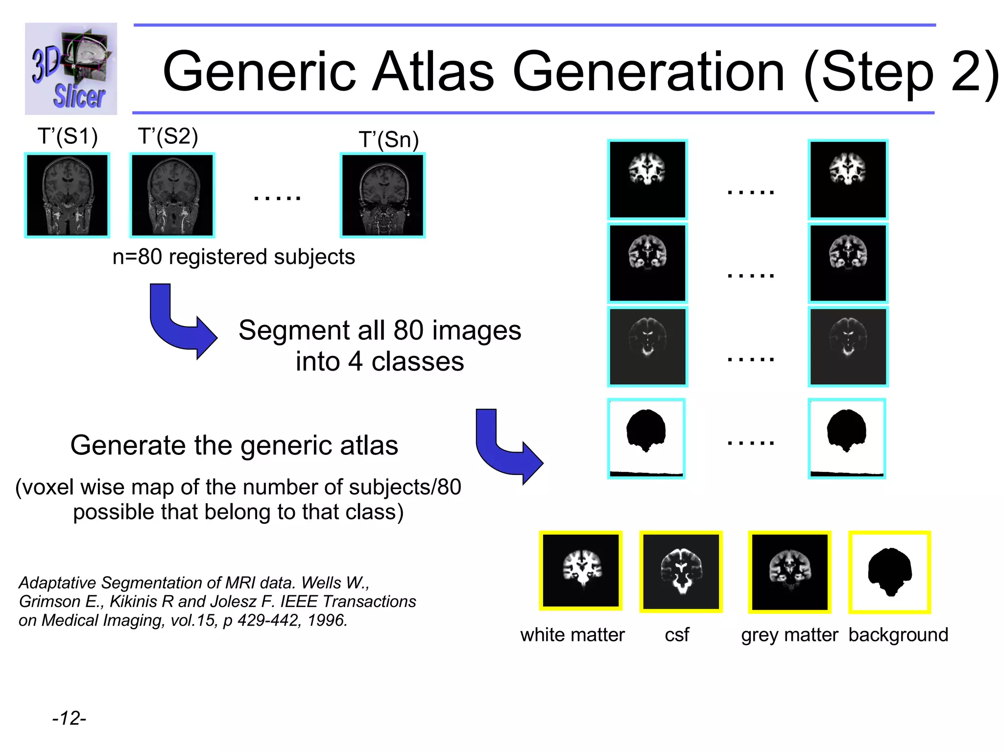 Segment all 80 images into 4 classes … .. T’(S1) T’(S2) T’(Sn) n=80 registered subjects … .. … .. … .. … .. Generate the generic atlas  (voxel wise map of the number of subjects/80 possible that belong to that class) Adaptative Segmentation of MRI data. Wells W., Grimson E., Kikinis R and Jolesz F. IEEE Transactions on Medical Imaging, vol.15, p 429-442, 1996. Generic Atlas Generation (Step 2) white matter csf grey matter background 
