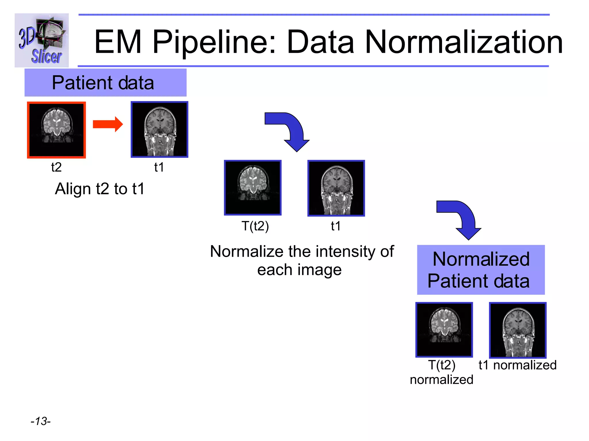 EM Pipeline: Data Normalization Align t2 to t1 Normalize the intensity of each image  t2 t1 Patient data  Normalized Patient data  t1 T(t2) t1 normalized T(t2) normalized 
