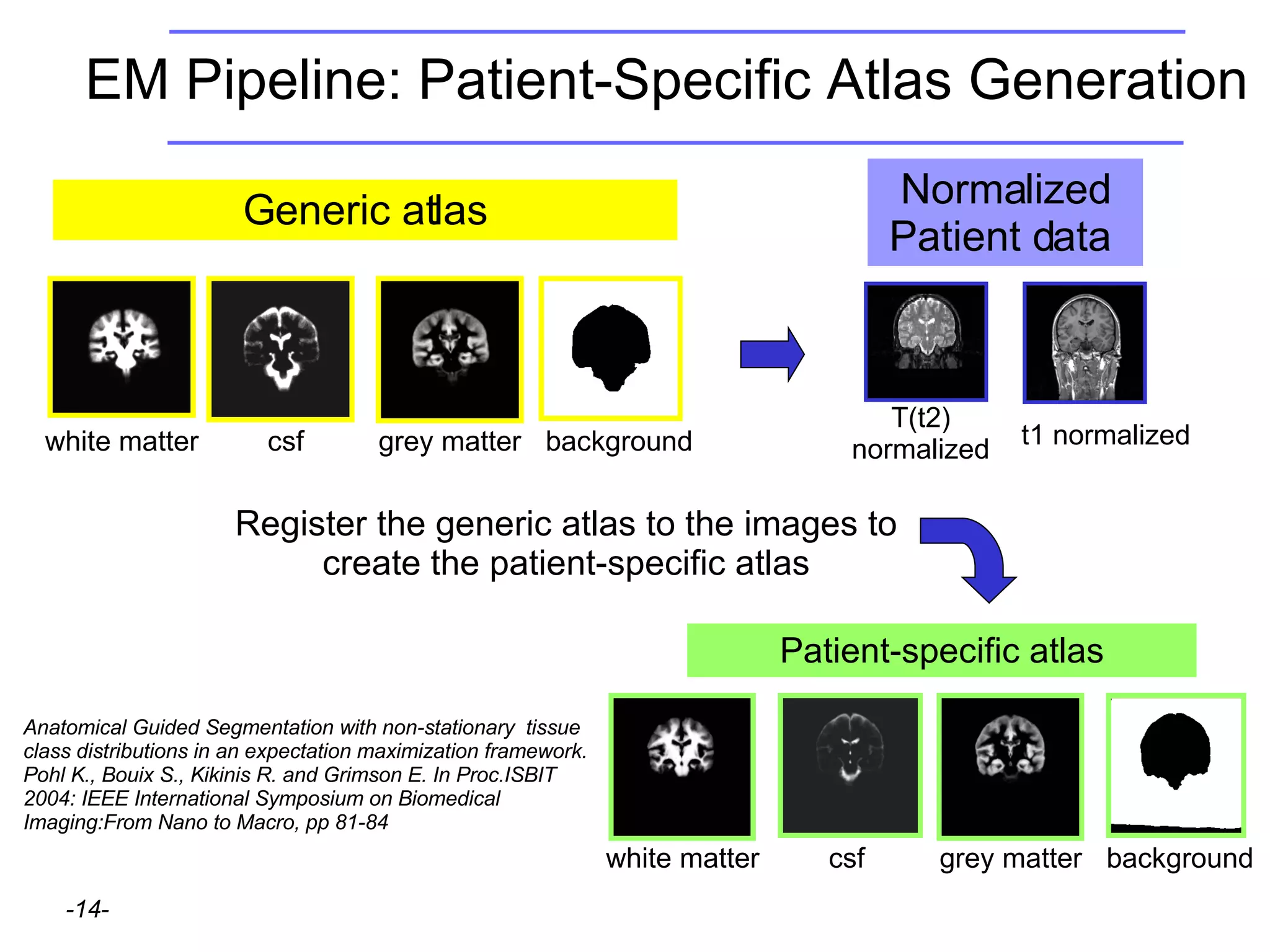 EM Pipeline: Patient-Specific Atlas Generation Register the generic atlas to the images to create the patient-specific atlas white matter csf grey matter background Generic atlas Anatomical Guided Segmentation with non-stationary  tissue class distributions in an expectation maximization framework. Pohl K., Bouix S., Kikinis R. and Grimson E. In Proc.ISBIT 2004: IEEE International Symposium on Biomedical Imaging:From Nano to Macro, pp 81-84 Patient-specific atlas white matter csf grey matter background Normalized Patient data  t1 normalized T(t2) normalized 