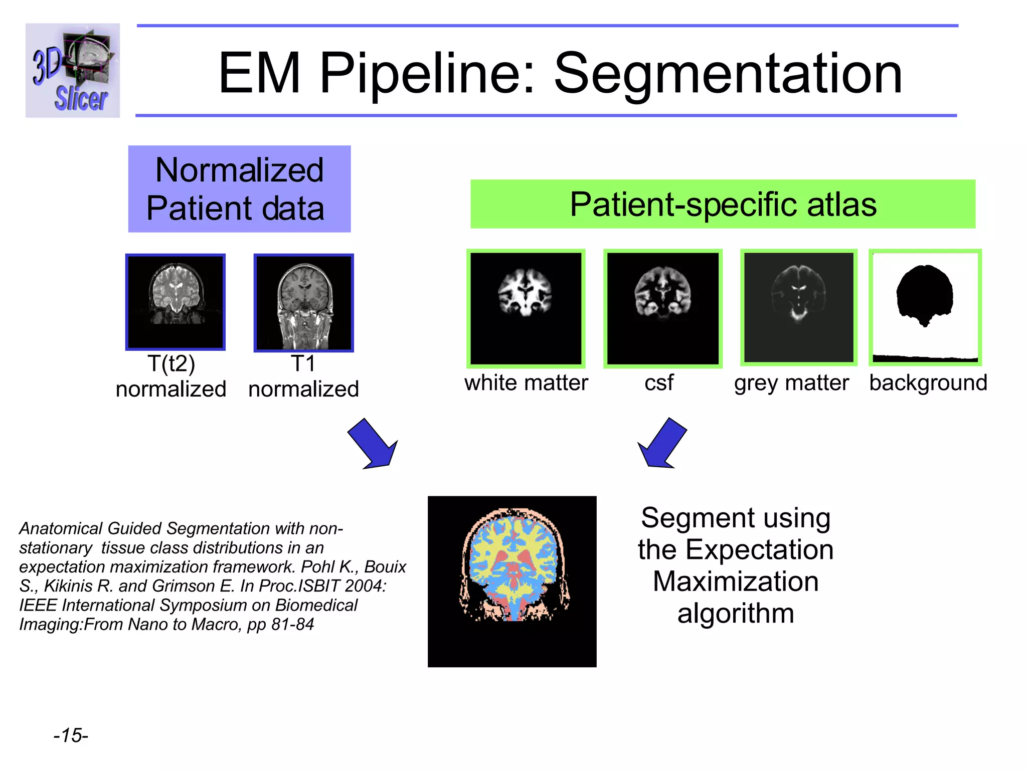 EM Pipeline: Segmentation Patient-specific atlas white matter csf grey matter background Segment using the Expectation Maximization algorithm Normalized Patient data  Anatomical Guided Segmentation with non-stationary  tissue class distributions in an expectation maximization framework. Pohl K., Bouix S., Kikinis R. and Grimson E. In Proc.ISBIT 2004: IEEE International Symposium on Biomedical Imaging:From Nano to Macro, pp 81-84 T1 normalized T(t2) normalized 