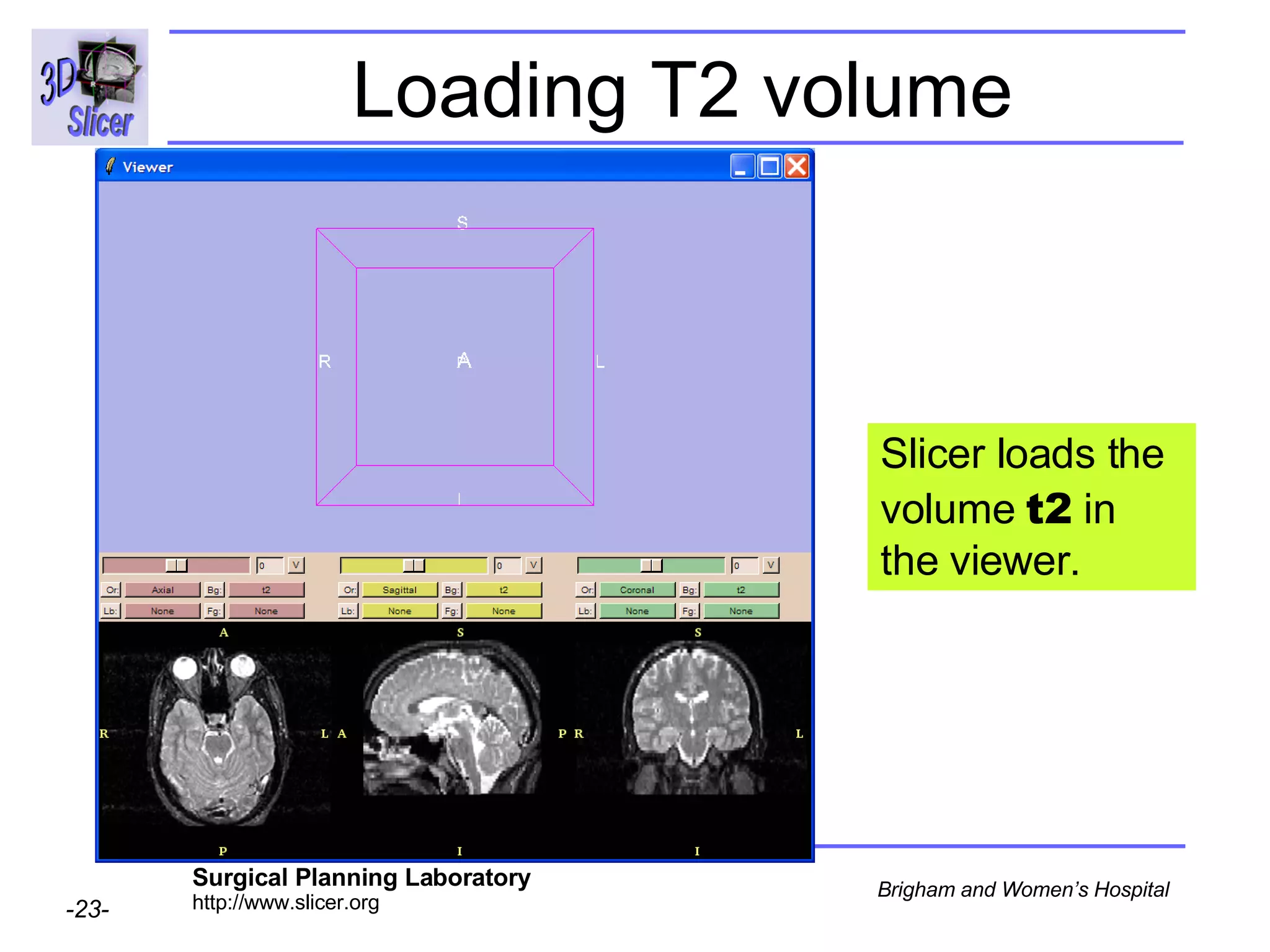 Loading T2 volume Slicer loads the volume  t2  in the viewer. 