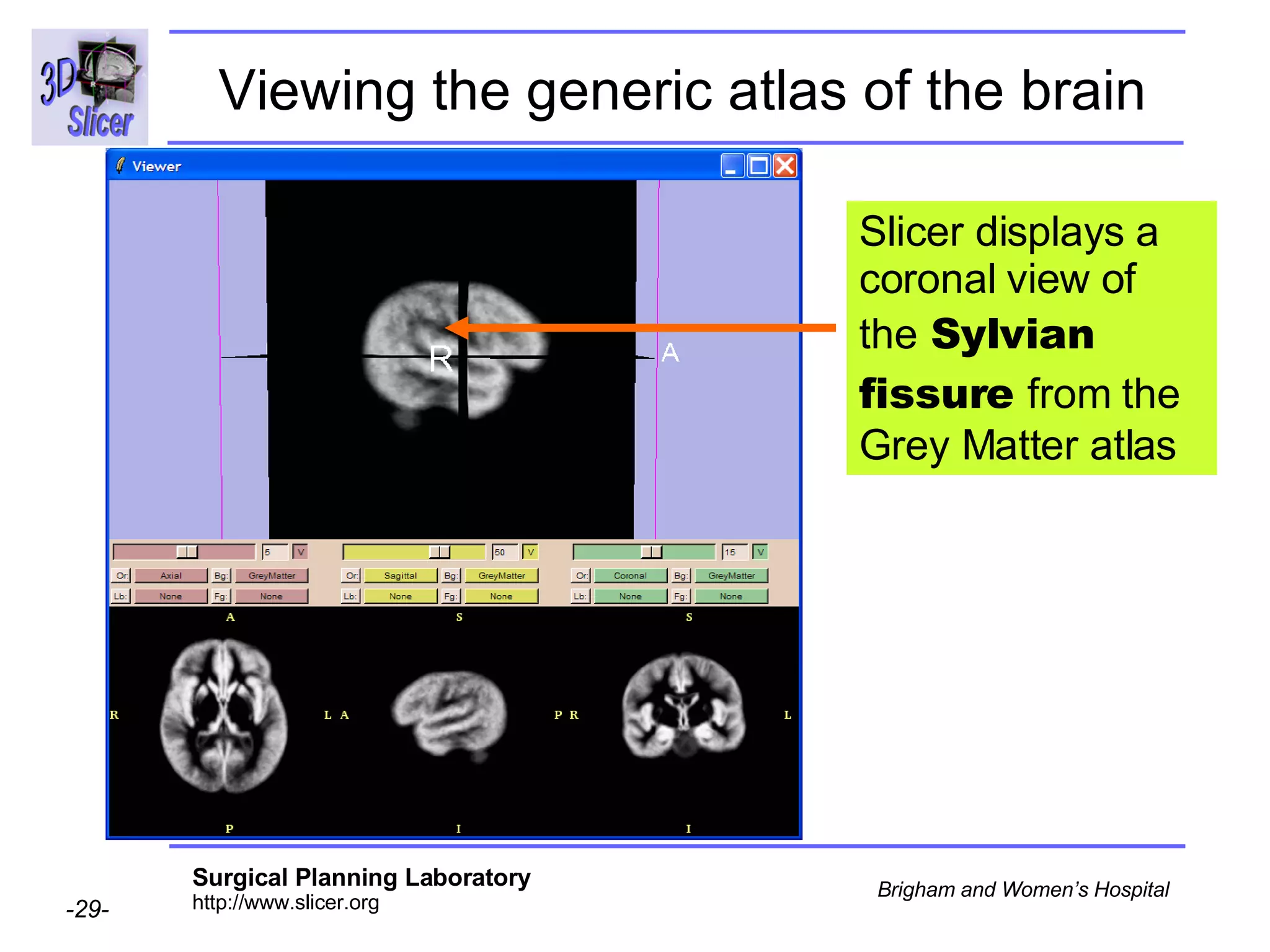 Viewing the generic atlas of the brain Slicer displays a coronal view of the  Sylvian fissure  from the Grey Matter atlas 