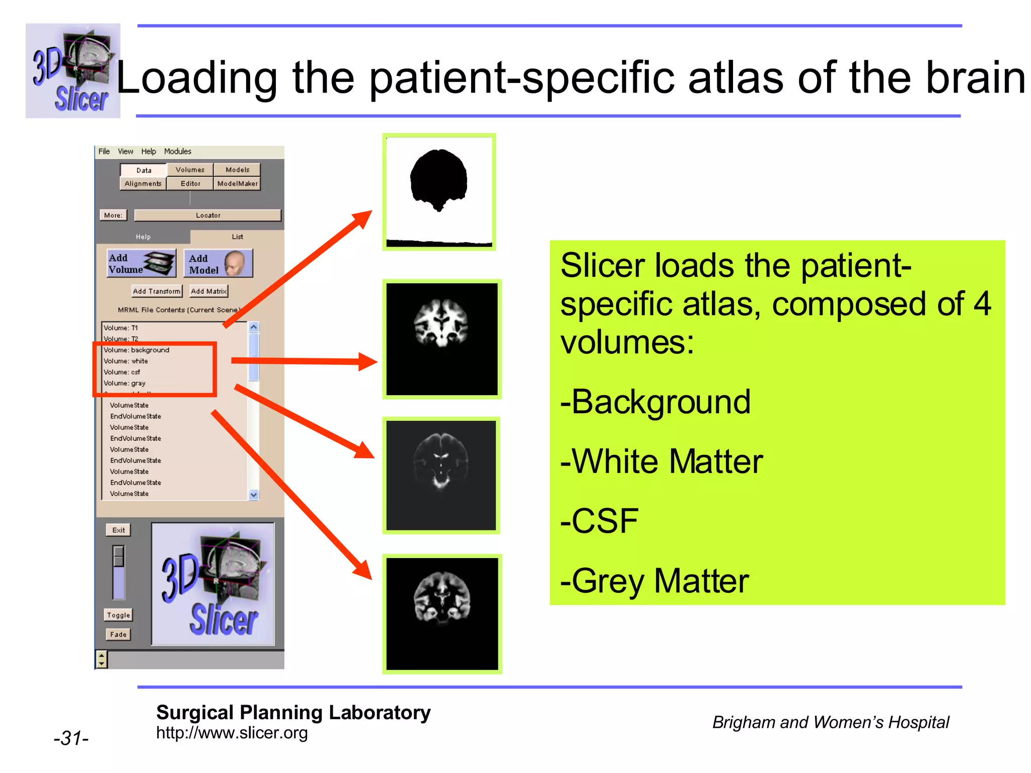 Loading the patient-specific atlas of the brain   Slicer loads the patient-specific atlas, composed of 4 volumes:  Background  White Matter CSF  Grey Matter  