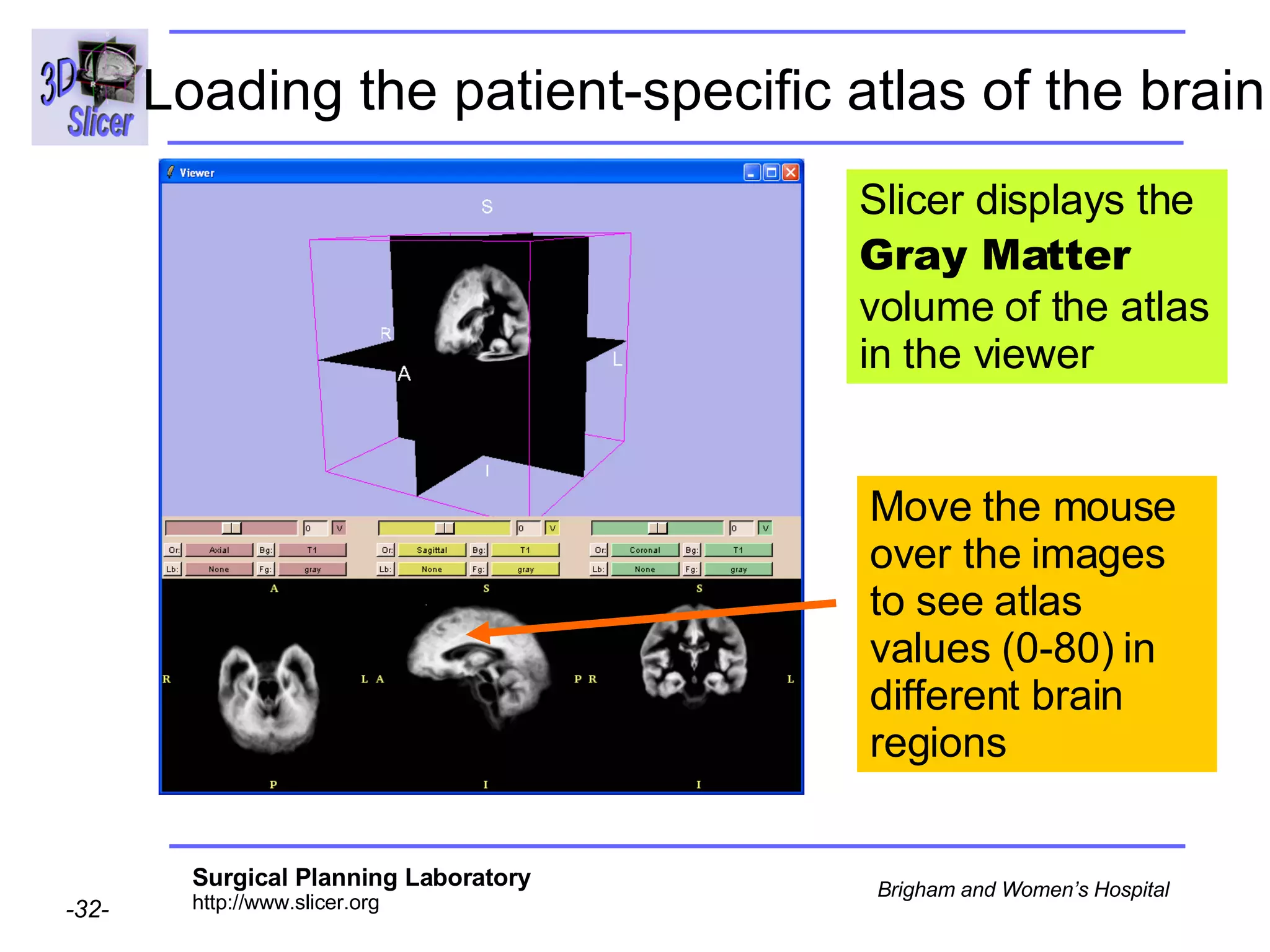 Loading the patient-specific atlas of the brain Slicer displays the  Gray Matter  volume of the atlas in the viewer Move the mouse over the images to see atlas values (0-80) in different brain regions 