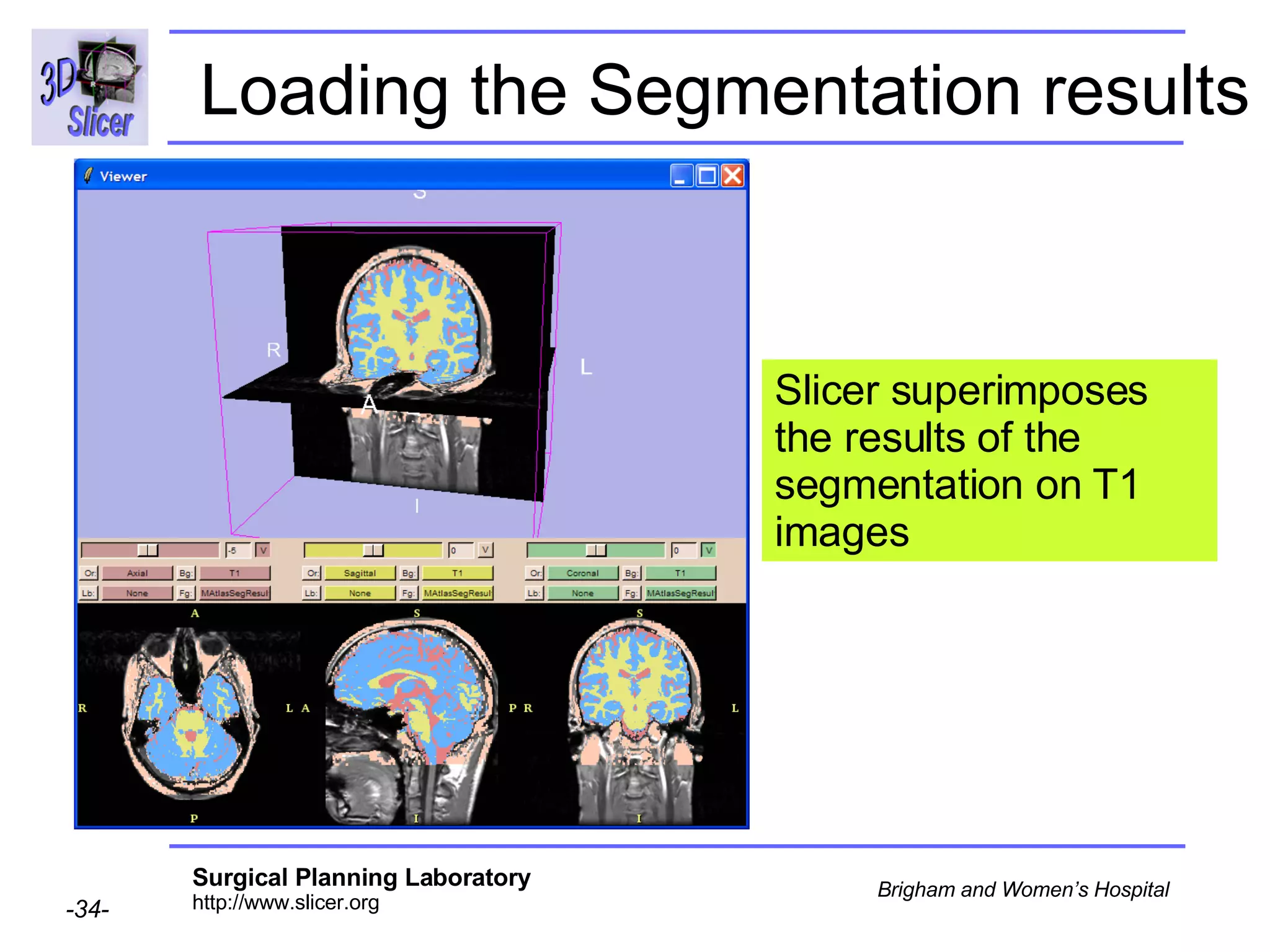 Loading the Segmentation results Slicer superimposes the results of the segmentation on T1 images 