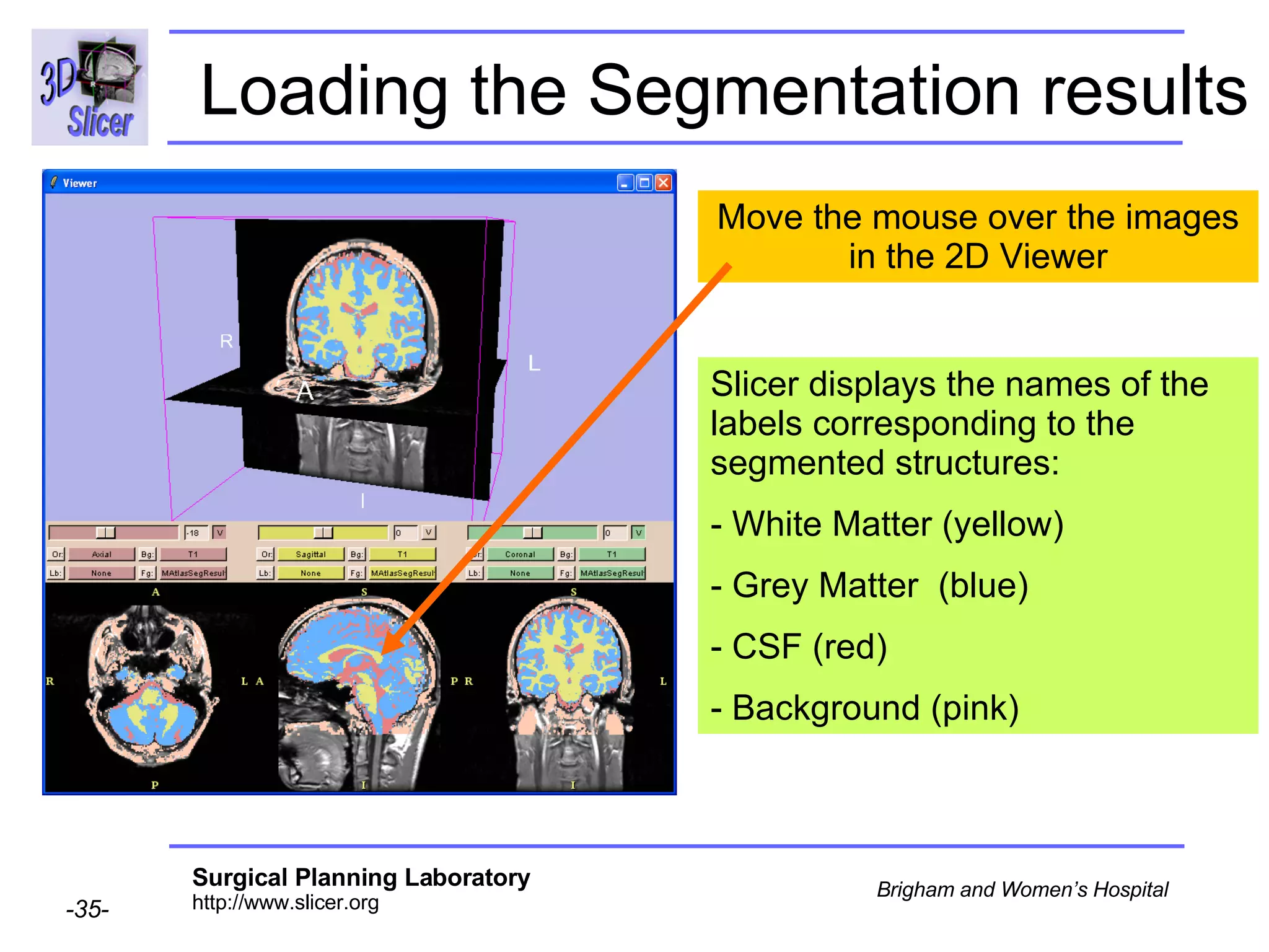 Loading the Segmentation results Move the mouse over the images in the 2D Viewer Slicer displays the names of the labels corresponding to the segmented structures:  - White Matter (yellow)  Grey Matter  (blue) CSF (red)  Background (pink)  