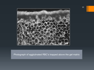23
Photograph of agglutinated RBC’s trapped above the gel matrix
 
