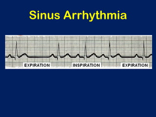 Sinus Arrhythmia
 