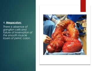 4. Megacolon:
There is absence of
ganglion cells and
failure of innervation of
the smooth muscle
layers of pelvic colon.
 