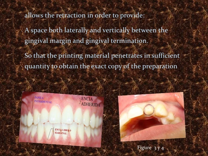 Gingival retraction thread