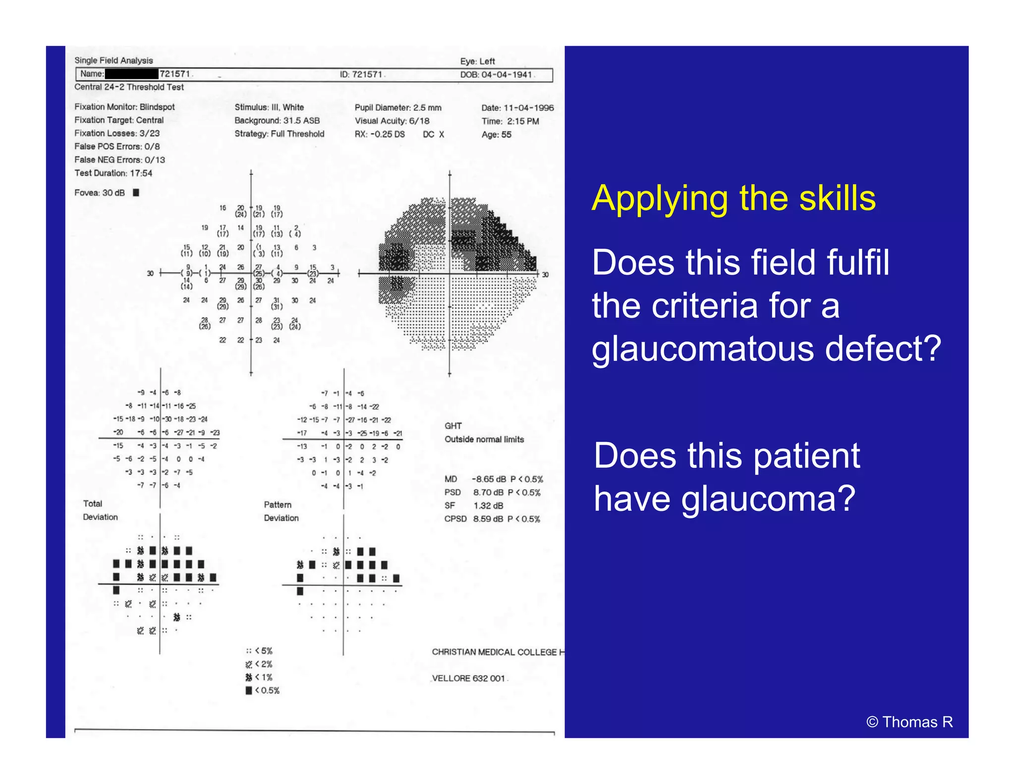 Applying the skills
Does this field fulfil
the criteria for a
glaucomatous defect?
Does this patient
have glaucoma?
© Thomas R
 