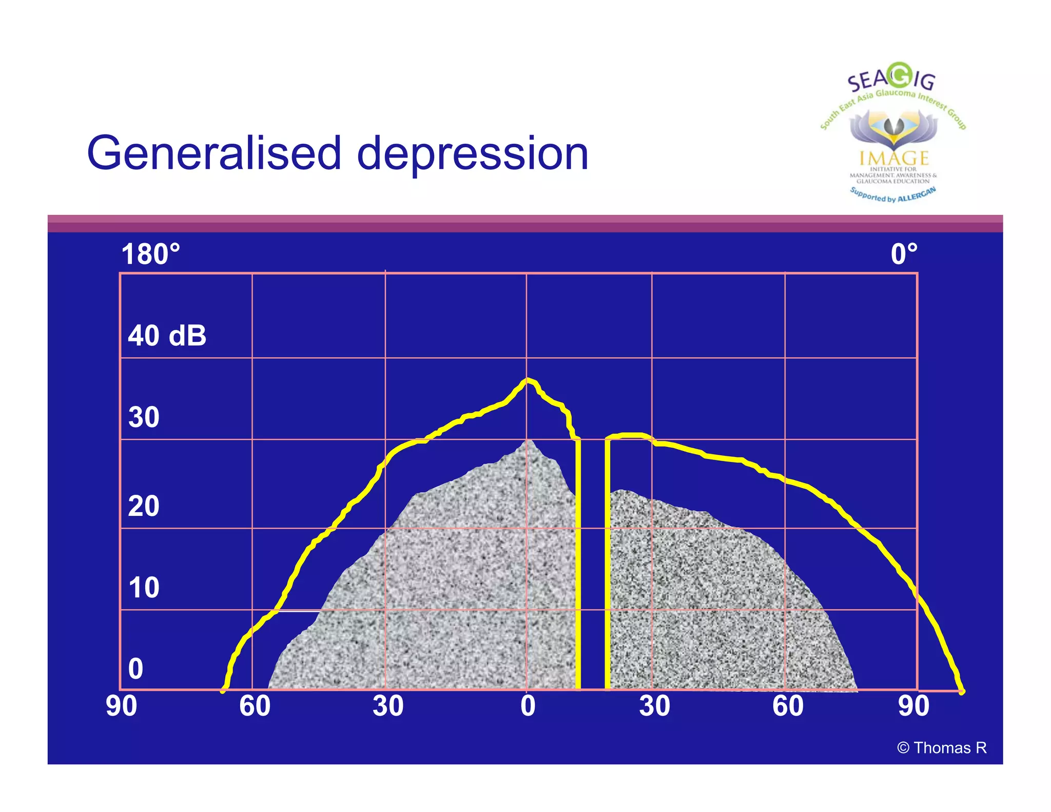 © Thomas R
180° 0°
40 dB
0
30
20
10
90 60 30 0 30 60 90
Generalised depression
 