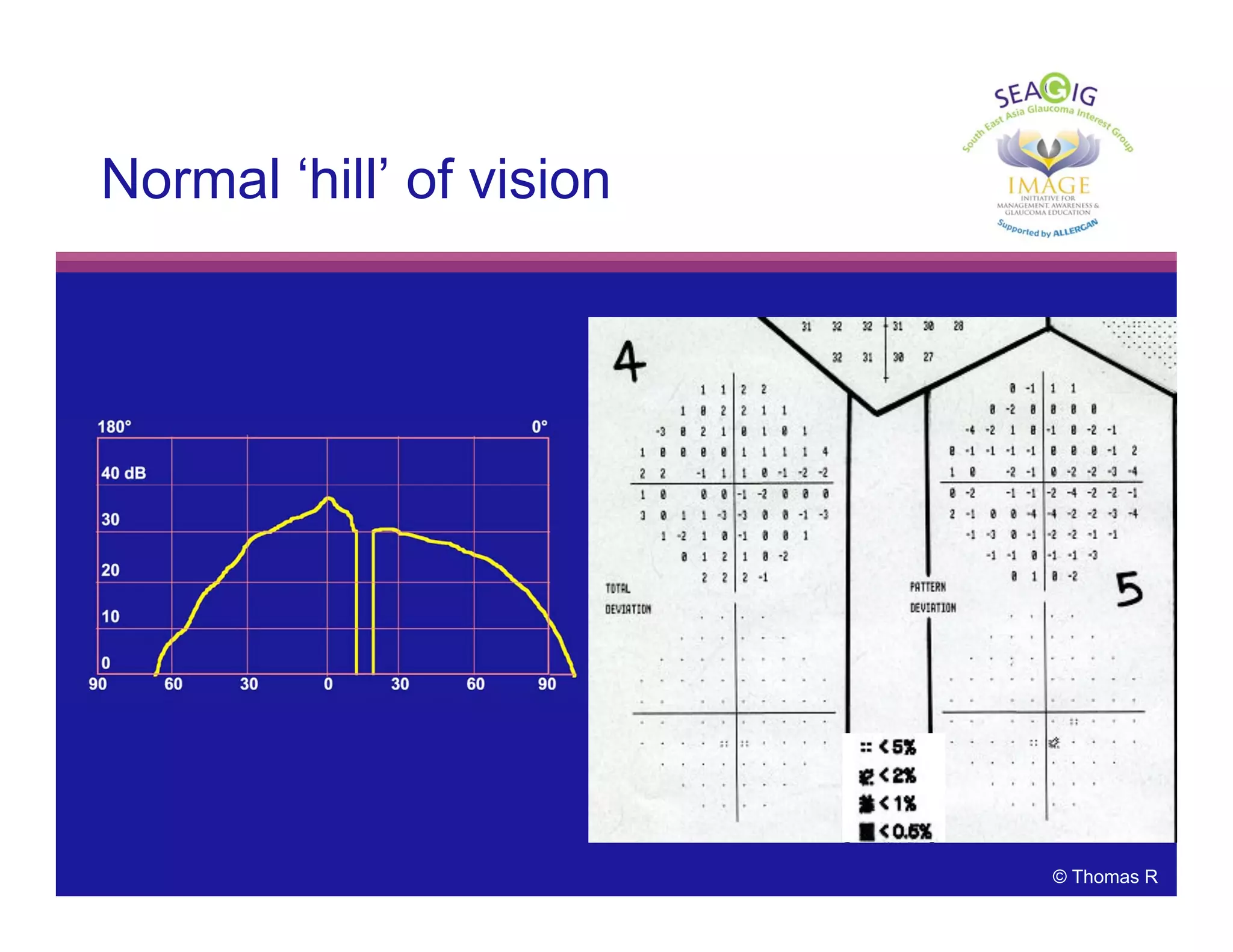 © Thomas R
Normal ‘hill’ of vision
 