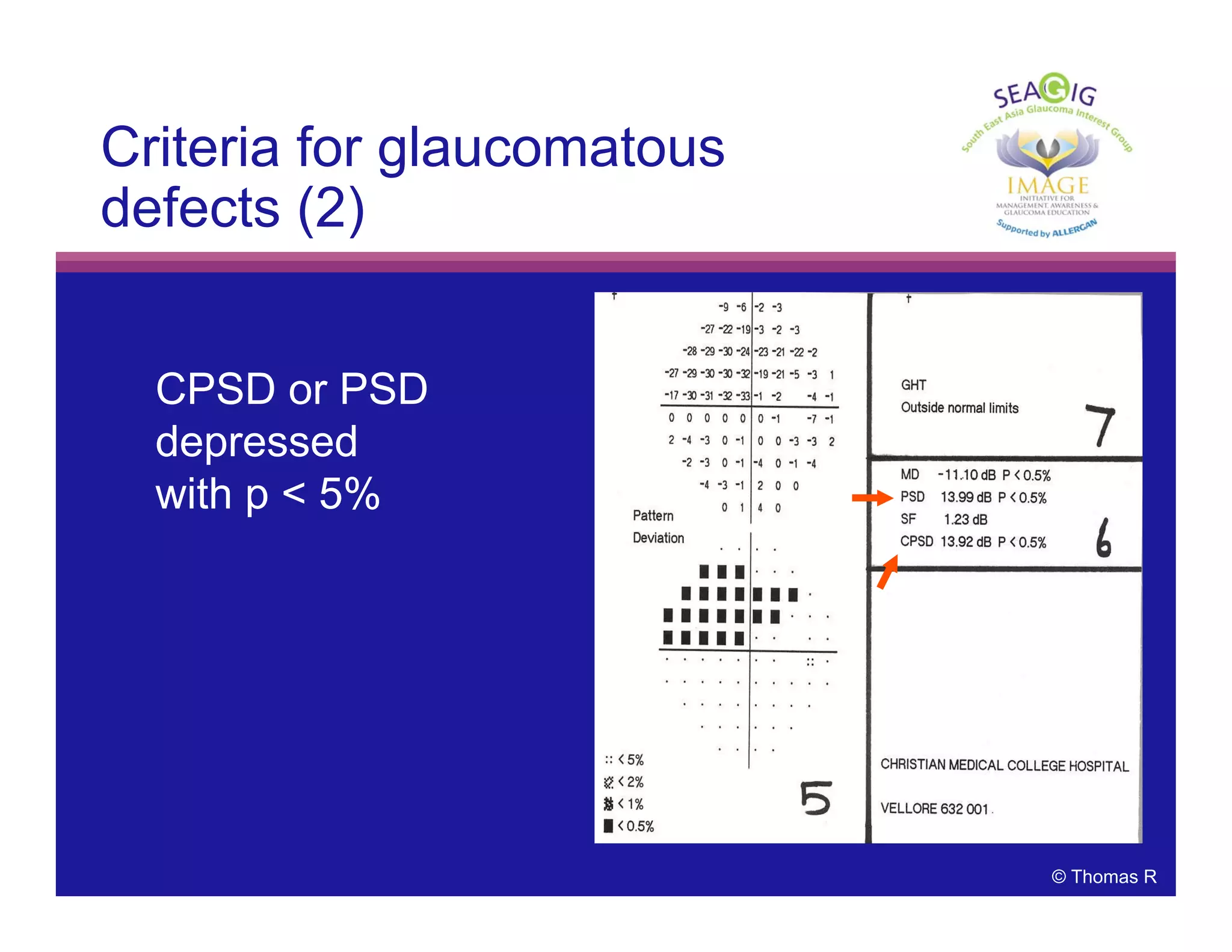 © Thomas R
Criteria for glaucomatous
defects (2)
CPSD or PSD
depressed
with p < 5%
 